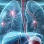 World Microbiome Day: What Can the Gut Microbiome Teach Us About Lung Disease?